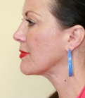 Feel Beautiful - Liposuction of Neck - After Photo